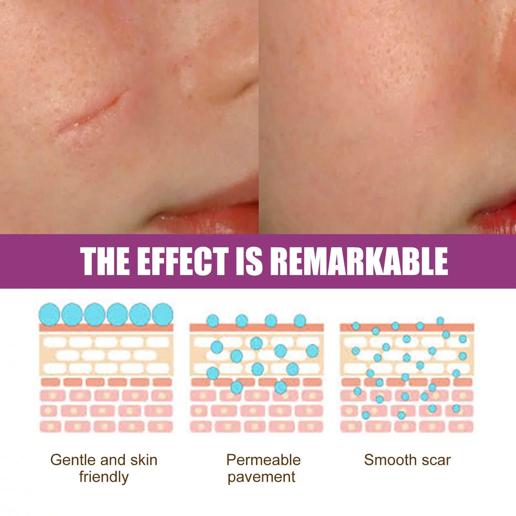 Scar Scar Removal Repair Scar Skin 50ml Repair Cream 2PCS and Cream Removal